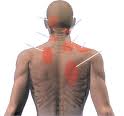 Whiplash Injury - Back Injury